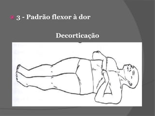  3 - Padrão flexor à dor 
Decorticação 
 