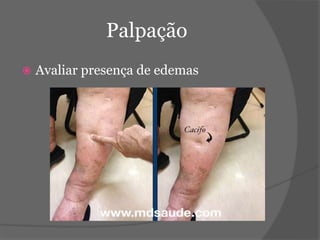 Palpação 
 Avaliar presença de edemas 
 