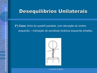 Leonardo Delgado
Desequilíbrios Unilaterais
Desequilíbrios Unilaterais
2°) Caso: linha do quadril paralela, com elevação do ombro
esquerdo – indicação de escoliose torácica esquerda simples.
 