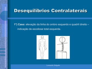 Leonardo Delgado
Desequilíbrios Contralaterais
Desequilíbrios Contralaterais
1°) Caso: elevação da linha do ombro esquerdo e quadril direito –
indicação de escoliose total esquerda.
 