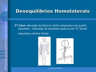 Leonardo Delgado
Desequilíbrios Homolaterais
Desequilíbrios Homolaterais
2°) Caso: elevação da linha do ombro esquerda e do quadril
esquerda – indicação de escoliose dupla ou em “S” dorsal
esquerda e lombar direita.
 