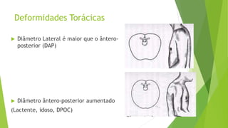 Deformidades Torácicas
 Diâmetro Lateral é maior que o ântero-
posterior (DAP)
 Diâmetro ântero-posterior aumentado
(Lactente, idoso, DPOC)
 