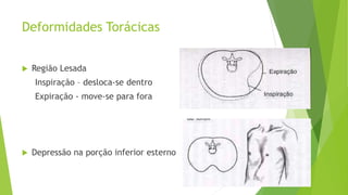 Deformidades Torácicas
 Região Lesada
Inspiração – desloca-se dentro
Expiração - move-se para fora
 Depressão na porção inferior esterno
 