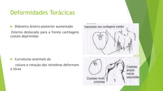 Deformidades Torácicas
 Diâmetro ântero-posterior aumentado
Esterno deslocado para a frente cartilagens
costais deprimidas
 Curvaturas anormais da
coluna e rotação das vértebras deformam
o tórax
 