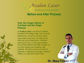Before and After Pictures
View Our Image Gallery of
Carlsbad and San Diego
Patients
At Avalon Laser, we strive to deliver
excellent San Diego laser hair removal
treatments, as well as various facial
rejuvenation services, including scar
removal, acne treatments, chemical
peels and more. In this presentation
you will find before and after images of
our San Diego Laser Medical Spa
patients. We also provide services to
patients in Carlsbad, Encinitas, Mission
Valley, La Jolla and Chula Vista.

Dr. Reza Tirgari

 