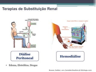 Terapias de Substituição Renal
Diálise
Peritoneal
Hemodiálise
Brunner, Suddart, 2011; Sociedade Brasileira de Nefrologia, 2016.
• Edema, Eletrólitos, Drogas
 