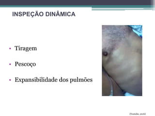 • Tiragem
• Pescoço
• Expansibilidade dos pulmões
(Youtube, 2016)
INSPEÇÃO DINÂMICA
 