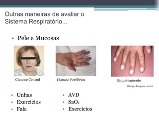 Outras maneiras de avaliar o
Sistema Respiratório...
• Pele e Mucosas
Cianose Central Cianose Periférica
• Unhas
• Exercícios
• Fala
Baqueteamento
(Google Imagens, 2016)
• AVD
• SaO2
• Exercícios
 