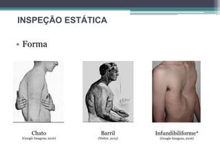 • Forma
INSPEÇÃO ESTÁTICA
Barril
(Netter, 2015)
Chato
(Google Imagens, 2016)
Infundibiliforme*
(Google Imagens, 2016)
 