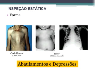 • Forma
Cariniforme
(Coelho, 2016)
Sino*
(Orfalaias et al, 1998)
INSPEÇÃO ESTÁTICA
Abaulamentos e Depressões
 