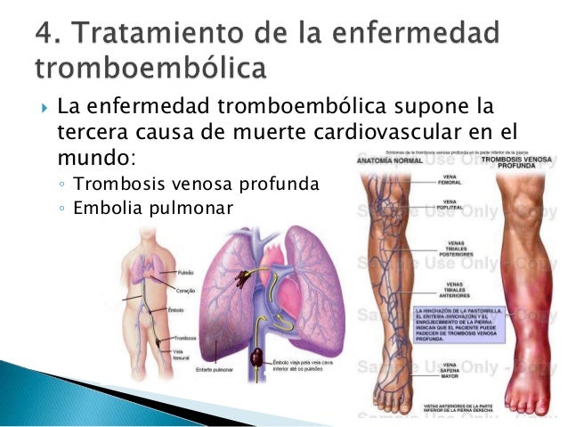 El cupón de los asteriscos vasculares