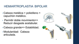 HEMIARTROPLASTIA BIPOLAR
• Cabeza metálica + polietileno +
capuchón metálico.
• Permitir doble movimiento>>
Reducir desgaste acetabular.
• Cabeza grande>> Estabilidad.
• Modularidad: Cabeza
articulada.
 