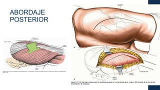 ABORDAJE
POSTERIOR
 
