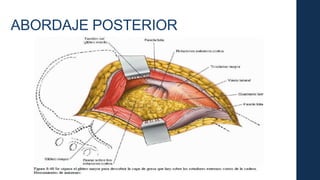 ABORDAJE POSTERIOR
 