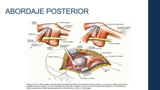 ABORDAJE POSTERIOR
 