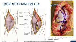 PARAROTULIANO MEDIAL
 