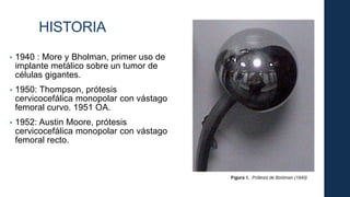 • 1940 : More y Bholman, primer uso de
implante metálico sobre un tumor de
células gigantes.
• 1950: Thompson, prótesis
cervicocefálica monopolar con vástago
femoral curvo. 1951 OA.
• 1952: Austin Moore, prótesis
cervicocefálica monopolar con vástago
femoral recto.
HISTORIA
 