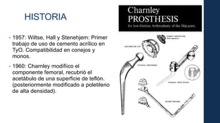 • 1957: Wiltse, Hall y Stenehjem: Primer
trabajo de uso de cemento acrílico en
TyO. Compatibilidad en conejos y
monos.
• 1960: Charnley modifiico el
componente femoral, recubrió el
acetábulo de una superficie de teflón.
(posteriormente modificado a poletileno
de alta densidad).
HISTORIA
 