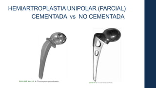 HEMIARTROPLASTIA UNIPOLAR (PARCIAL)
CEMENTADA vs NO CEMENTADA
 