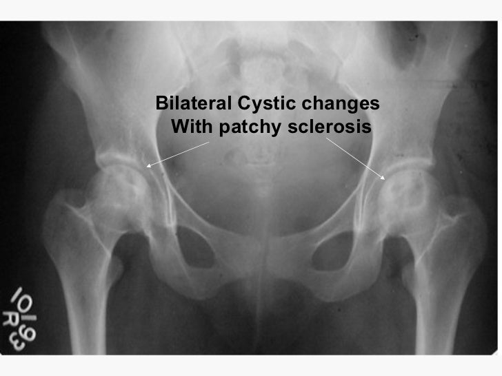 Avascular necrosis hip