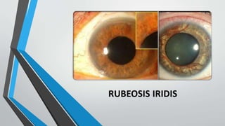 RUBEOSIS IRIDIS
 