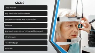 SIGNS
Ciliary injection
Hazy cornea from epithelial edema
Deep anterior chamber with moderate flare
Hyphema
New vessels on the iris and in the angle(Gonioscopy)
Ectropion uveae
Fixed dilated pupil
Raised IOP
 