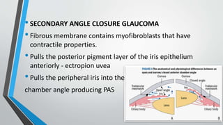 •SECONDARY ANGLE CLOSURE GLAUCOMA
•Fibrous membrane contains myofibroblasts that have
contractile properties.
•Pulls the posterior pigment layer of the iris epithelium
anteriorly - ectropion uvea
•Pulls the peripheral iris into the
chamber angle producing PAS
 