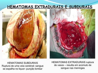 HEMATOMAS EXTRADURAIS E SUBDURAIS
HEMATOMAS SUBDURAIS
Ruptura de uma veia cerebral- sangue
se espalha no liquor- punção lombar
HEMATOMAS EXTRADURAIS ruptura
de vasos – resulta em acúmulo de
sangue nas meninges
 