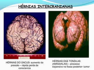 HÉRNIAS INTERCRANIANAS
HÉRNIAS DO ÚNCUS- aumento da
pressão – rápida perda da
consciencia
HÉRNIAS DAS TONSILAS
(AMÍGDALAS) – processo
expansivo na fossa posterior- tumor
 