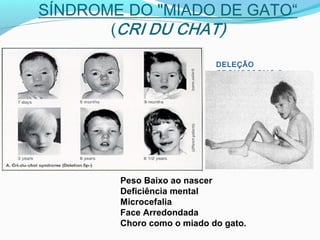 DELEÇÃO
CROMOSSOMO 5
Peso Baixo ao nascer
Deficiência mental
Microcefalia
Face Arredondada
Choro como o miado do gato.
 