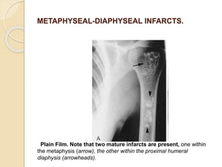 METAPHYSEAL-DIAPHYSEAL INFARCTS.
Plain Film. Note that two mature infarcts are present, one within
the metaphysis (arrow), the other within the proximal humeral
diaphysis (arrowheads).
 