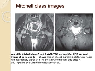 Mitchell class images
A and B: Mitchell class A and D AVN: T1W coronal (A), STIR coronal
image of both hips (B)—shows area of altered signal in both femoral heads
with fat intensity signal on T1W and STIR on the right side-class A
and hypointense signal on the left side-class D
 