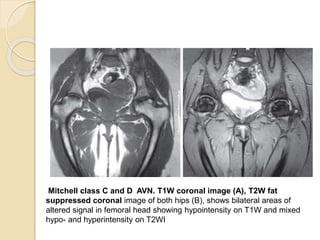Mitchell class C and D AVN. T1W coronal image (A), T2W fat
suppressed coronal image of both hips (B), shows bilateral areas of
altered signal in femoral head showing hypointensity on T1W and mixed
hypo- and hyperintensity on T2WI
 