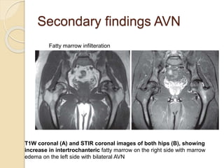 Secondary findings AVN
Fatty marrow infilteration
T1W coronal (A) and STIR coronal images of both hips (B), showing
increase in intertrochanteric fatty marrow on the right side with marrow
edema on the left side with bilateral AVN
 