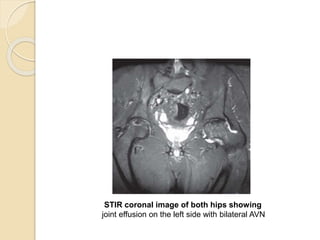 STIR coronal image of both hips showing
joint effusion on the left side with bilateral AVN
 