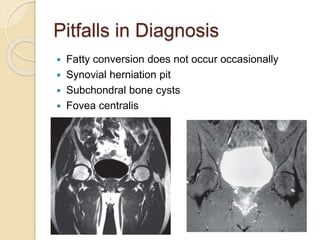 Pitfalls in Diagnosis
 Fatty conversion does not occur occasionally
 Synovial herniation pit
 Subchondral bone cysts
 Fovea centralis
 