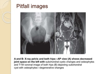 Pitfall images
A and B: X-ray pelvis and both hips—AP view (A) shows decreased
joint space on the left with subchondral cystic changes and osteophytes
and T1W coronal image of both hips (B) depicting subchondral
cyst with osteophytes—degenerative changes
 