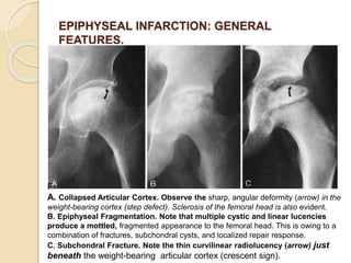 EPIPHYSEAL INFARCTION: GENERAL
FEATURES.
F
A. Collapsed Articular Cortex. Observe the sharp, angular deformity (arrow) in the
weight-bearing cortex (step defect). Sclerosis of the femoral head is also evident.
B. Epiphyseal Fragmentation. Note that multiple cystic and linear lucencies
produce a mottled, fragmented appearance to the femoral head. This is owing to a
combination of fractures, subchondral cysts, and localized repair response.
C. Subchondral Fracture. Note the thin curvilinear radiolucency (arrow) just
beneath the weight-bearing articular cortex (crescent sign).
 