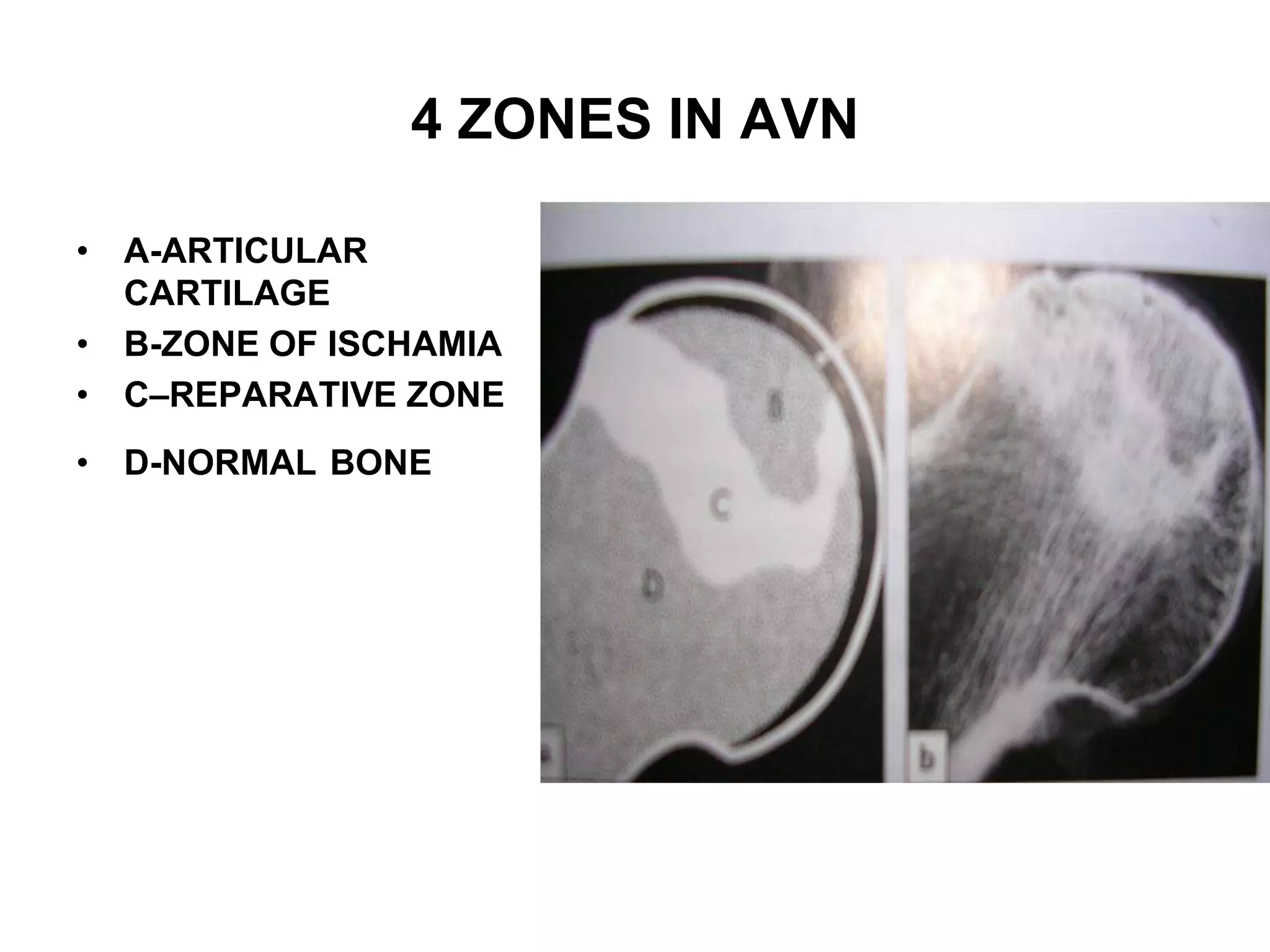 Avascular necrosis Radiology | PPTX
