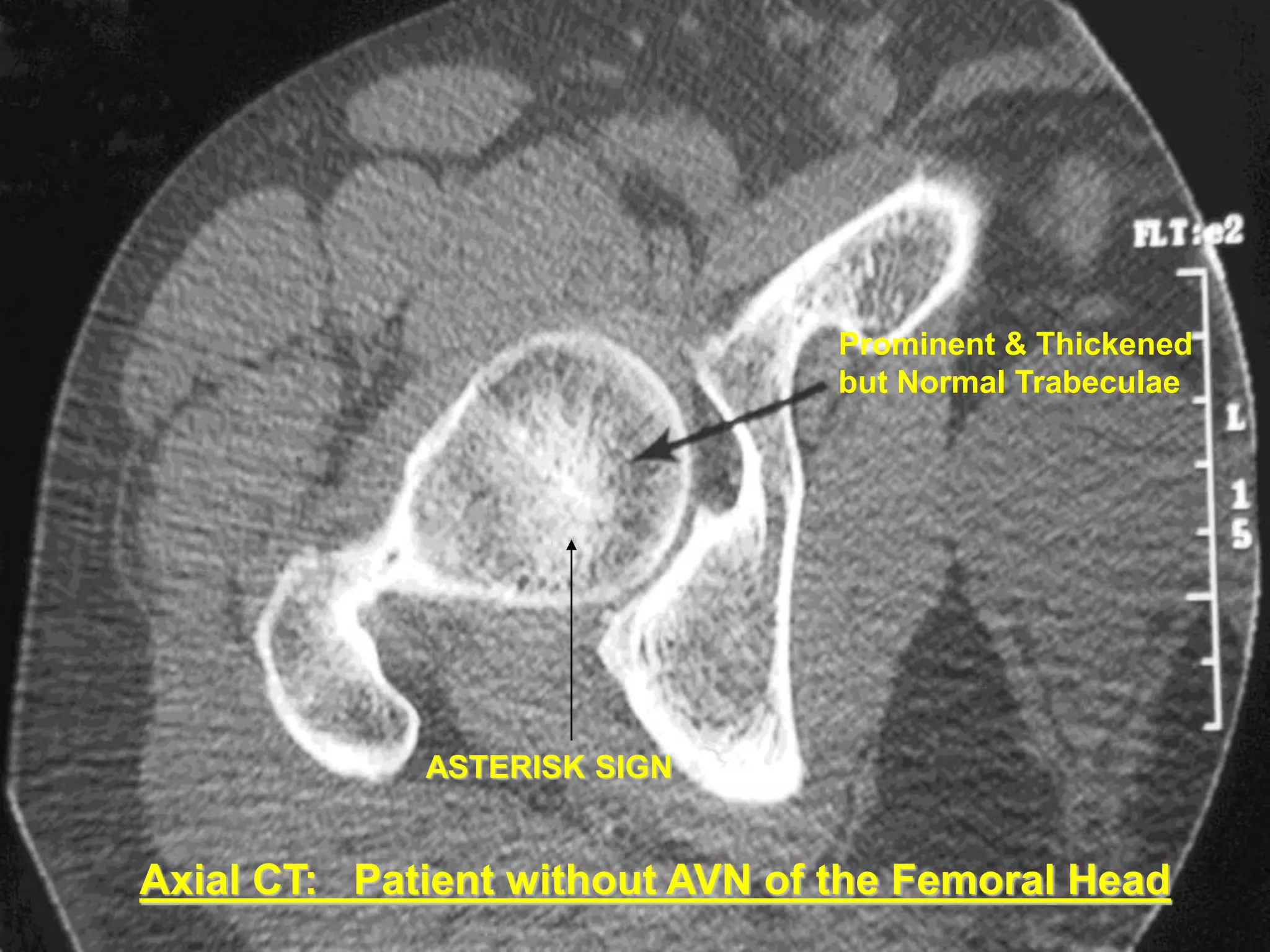 Avascular necrosis Radiology | PPTX