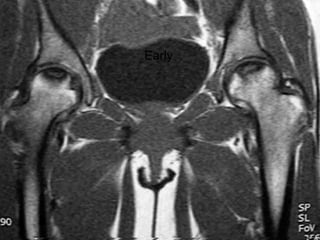 CORONAL T2-WEIGHTED MRI
 