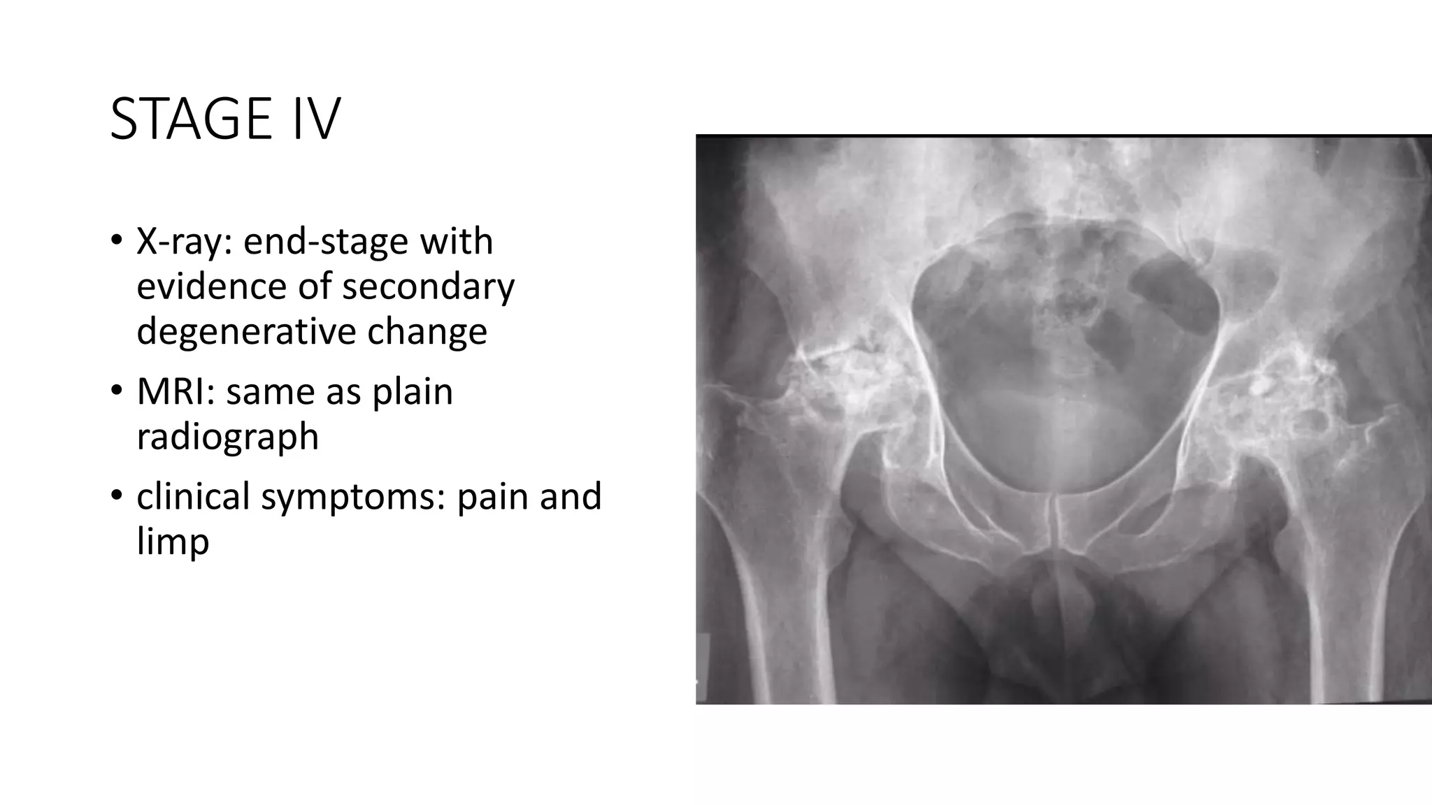 Avascular necrosis of Hip - treatment modalities and current concepts.pptx