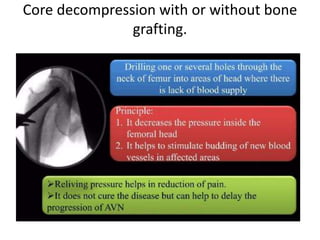 Avascular Necrosis Of Femoral Head.pptx