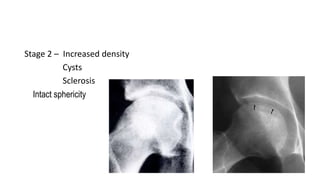 Avascular necrosis of femoral head 1456920705296 | PPTX