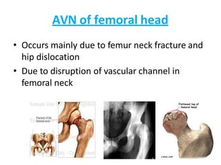 AVN of femoral head
• Occurs mainly due to femur neck fracture and
hip dislocation
• Due to disruption of vascular channel in
femoral neck
 