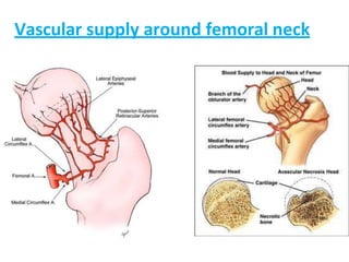Vascular supply around femoral neck
 