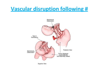 Vascular disruption following #
 