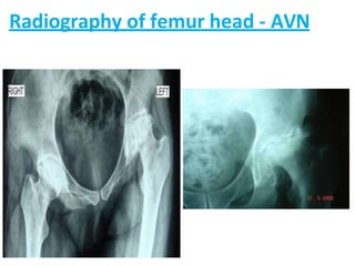 Radiography of femur head - AVN
 