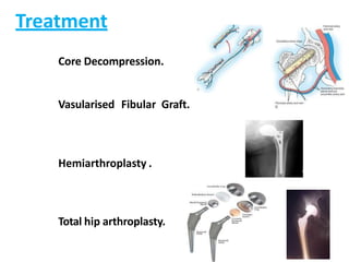 Treatment
Core Decompression.
Vasularised Fibular Graft.
Hemiarthroplasty .
Total hip arthroplasty.
 