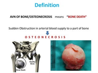 Definition
AVN OF BONE/OSTEONECROSIS means “BONE DEATH”
Sudden Obstruction in arterial blood supply to a part of bone
O S T E O N E C R O S I S
 